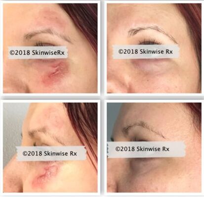 Scar reduction, scar treatment, laser treatment, LaseMD, Skin of Color expert