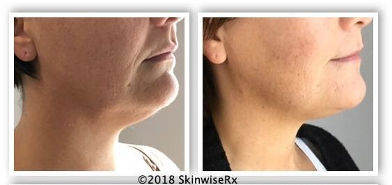 Kybella non-surgical injections to reduce neck fat and under chin fat cells.