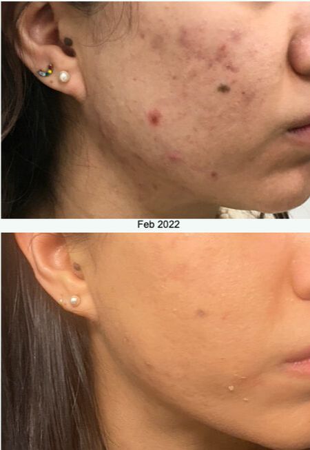 Microneedling, radiofrequency microneedling, wrinkles, acne scars, cellulite, skin of color expert
